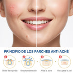 Parche anti acné - Suavidad instantánea